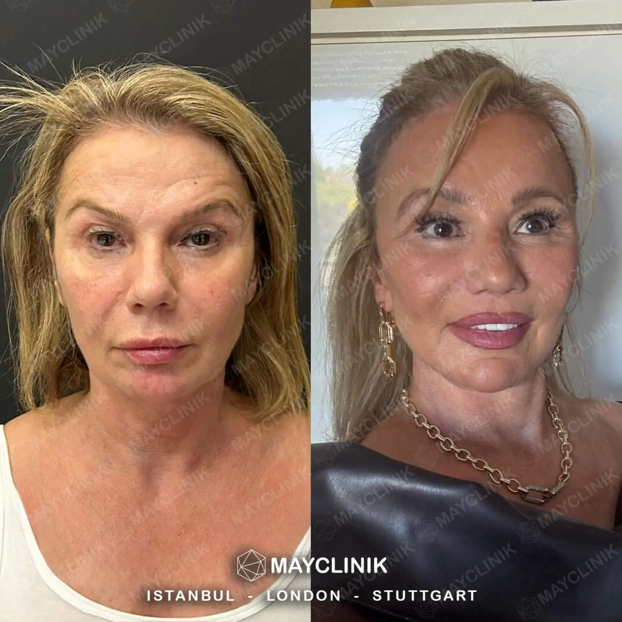 Deep Plane Facelift Before After Result 10