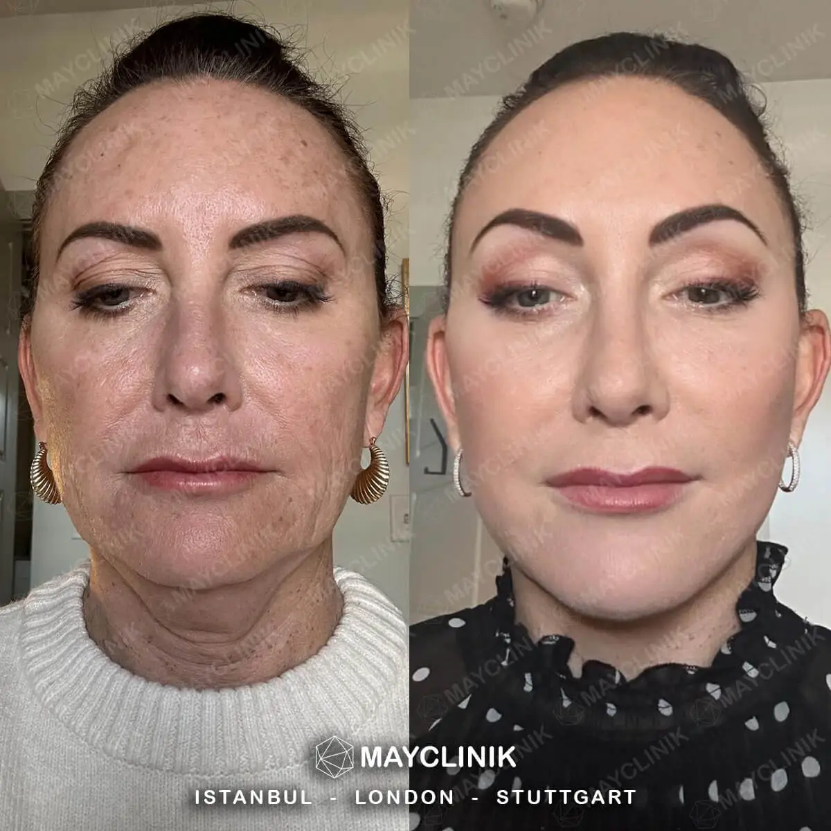 Deep Plane Facelift Before After Result 11