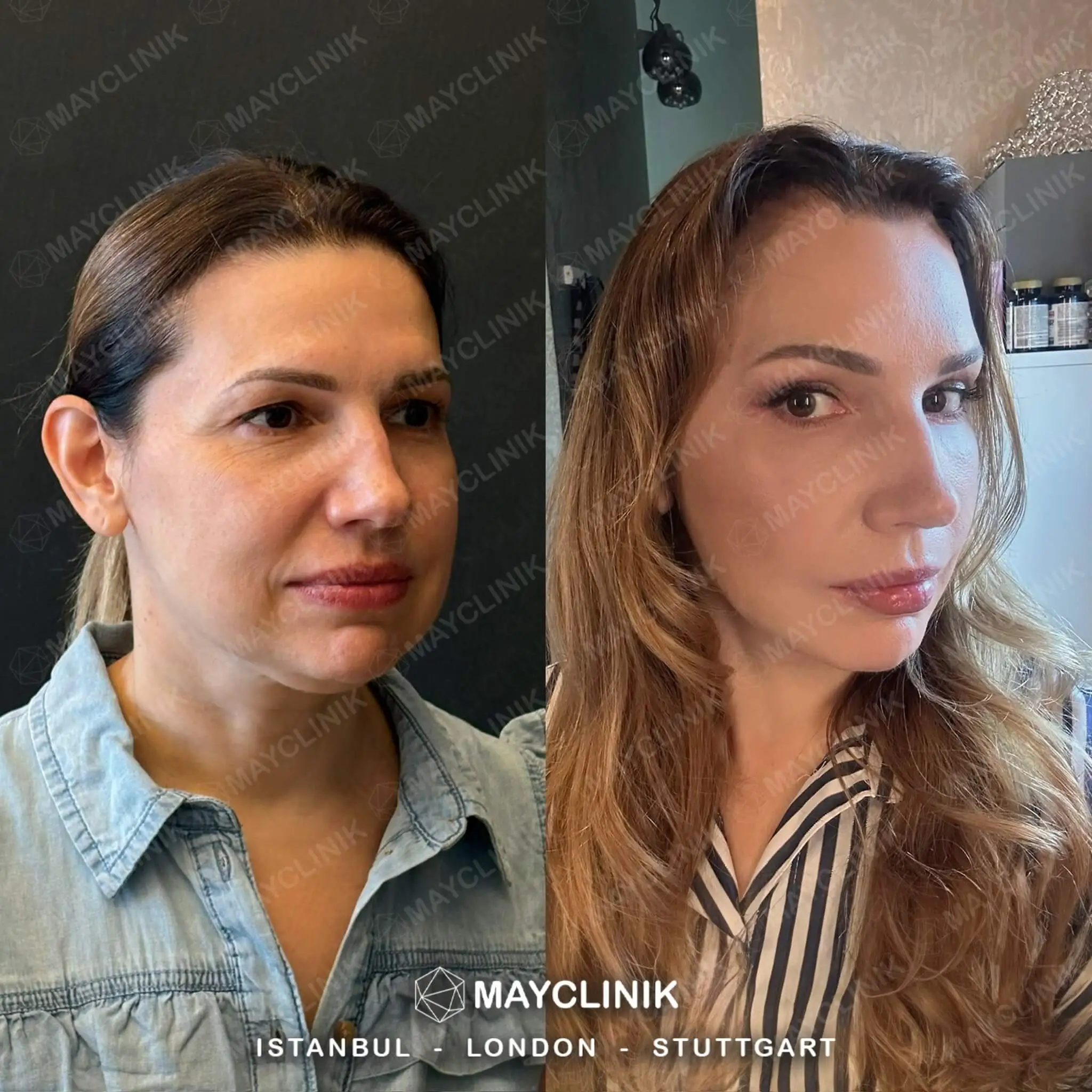 Deep Plane Facelift Before After Result 12