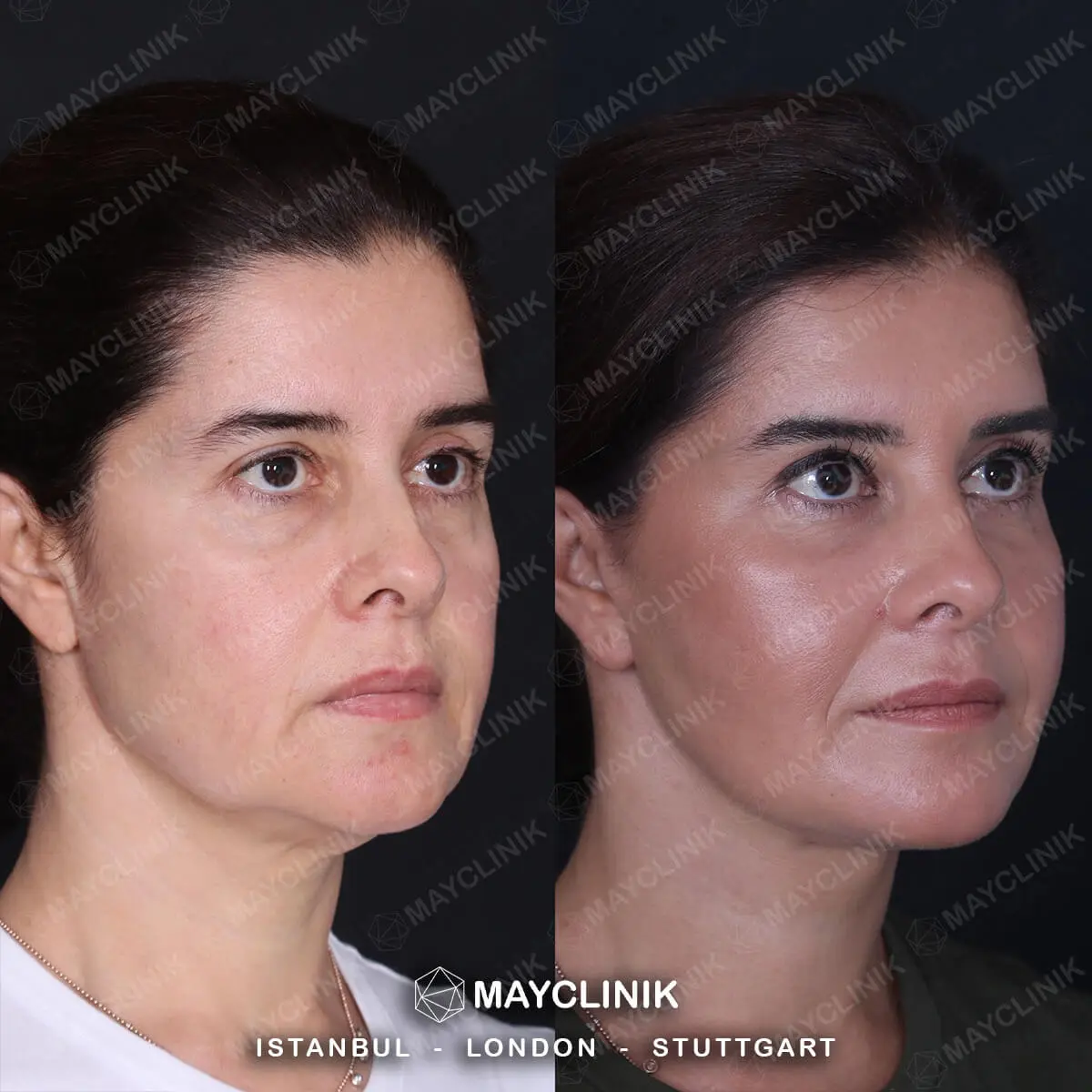 Deep Plane Facelift Before After Result 13