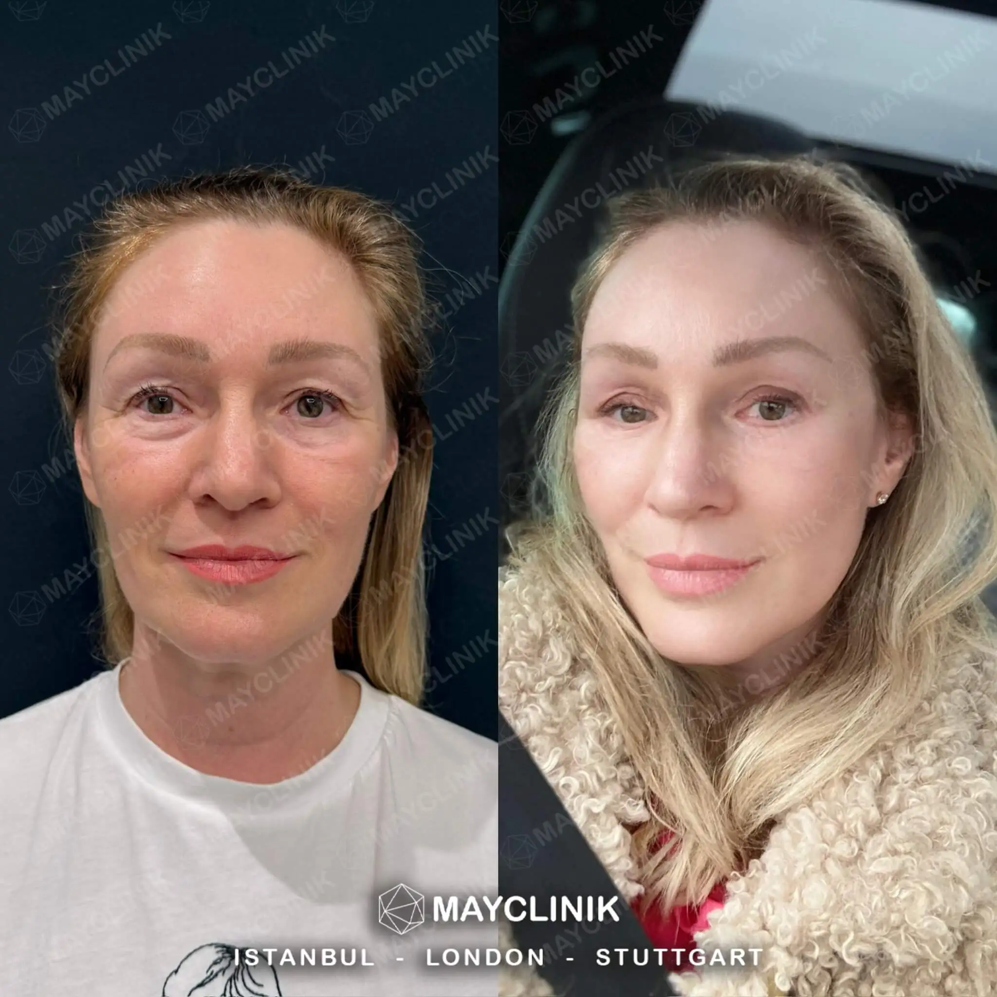 Deep Plane Facelift Before After Result 8