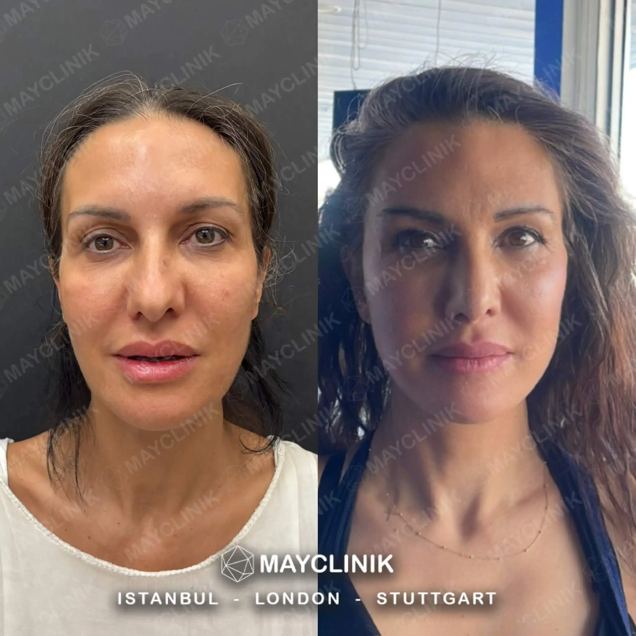 Deep Plane Facelift Before After Result 9