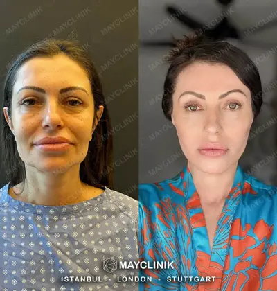 Deep Plane Facelift Before After Result 7