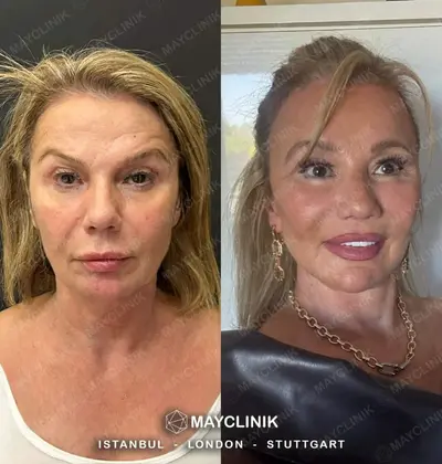 Deep Plane Facelift Before After Result 10