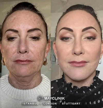 Deep Plane Facelift Before After Result 11