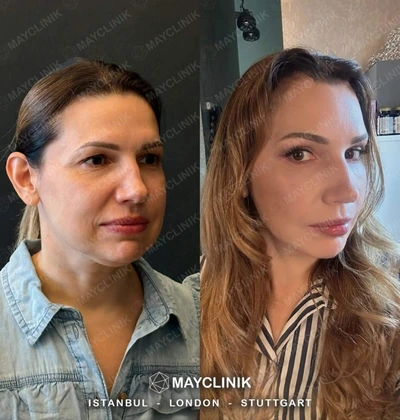 Deep Plane Facelift Before After Result 12