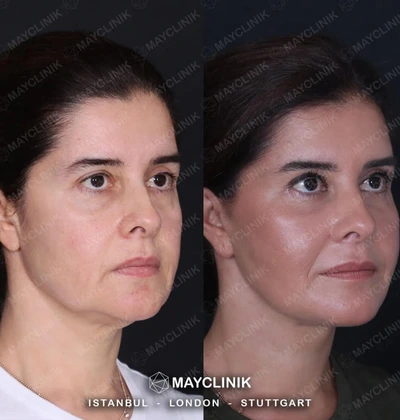 Deep Plane Facelift Before After Result 13