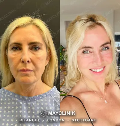 Deep Plane Facelift Before After Result 6