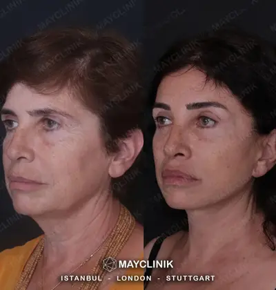 Deep Plane Facelift Before After Result 1