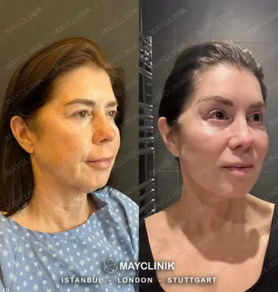 Deep Plane Facelift Before After Result 4
