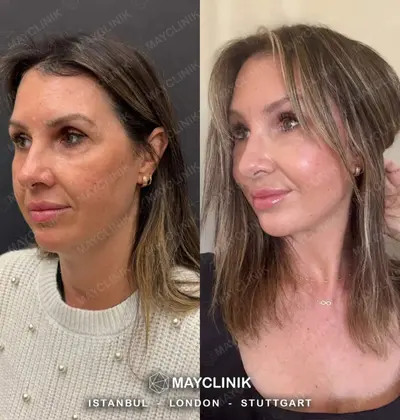 Deep Plane Facelift Before After Result 5
