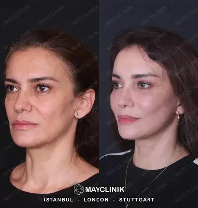 Deep Plane Facelift Before After Result 2