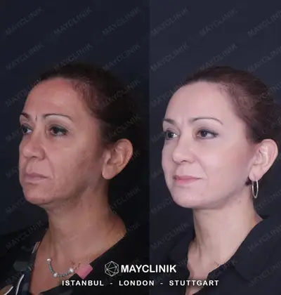 Deep Plane Facelift Before After Result 3