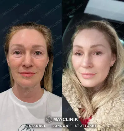 Deep Plane Facelift Before After Result 8