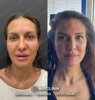 Deep Plane Facelift Before After Result 9