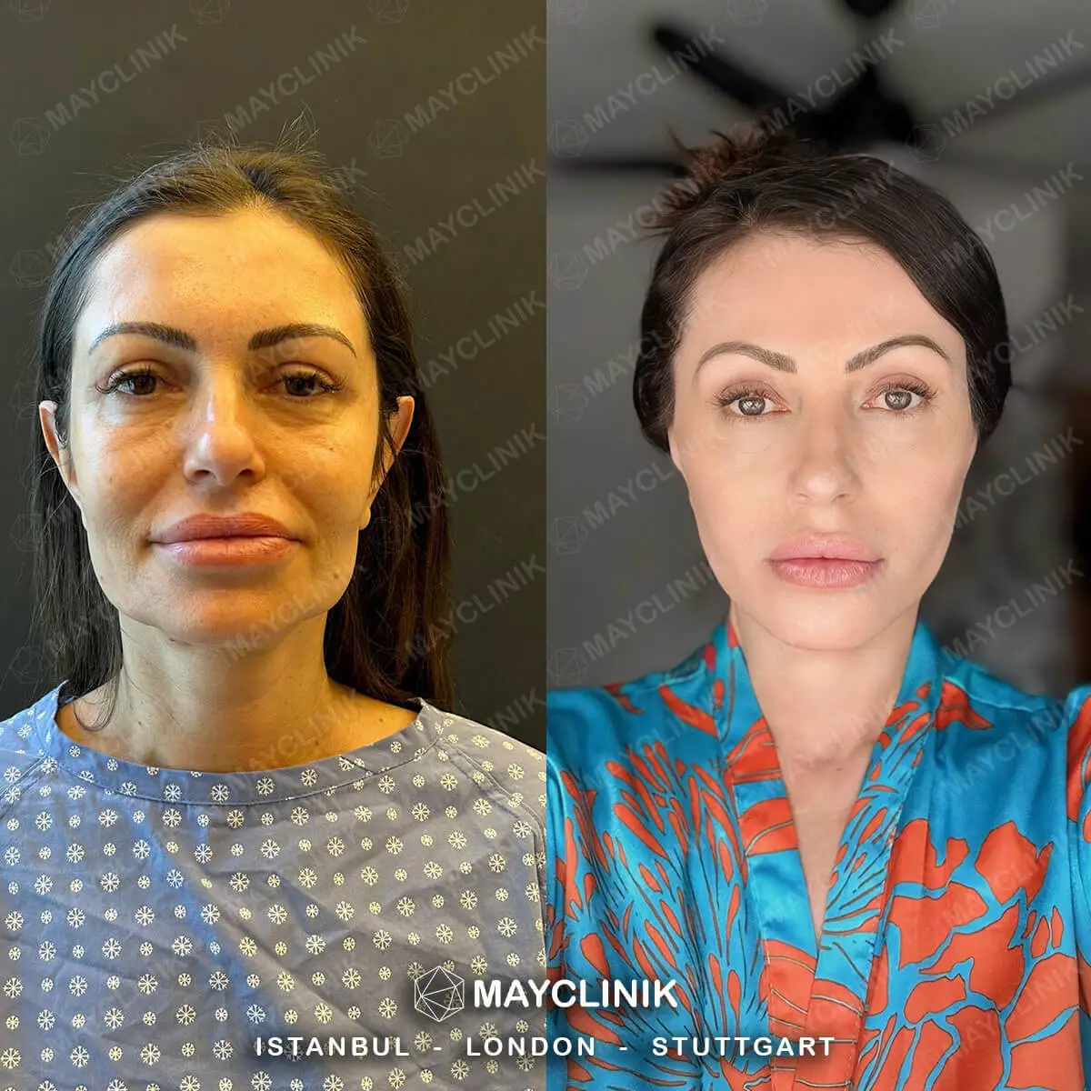 Deep Plane Facelift Before After Result 7