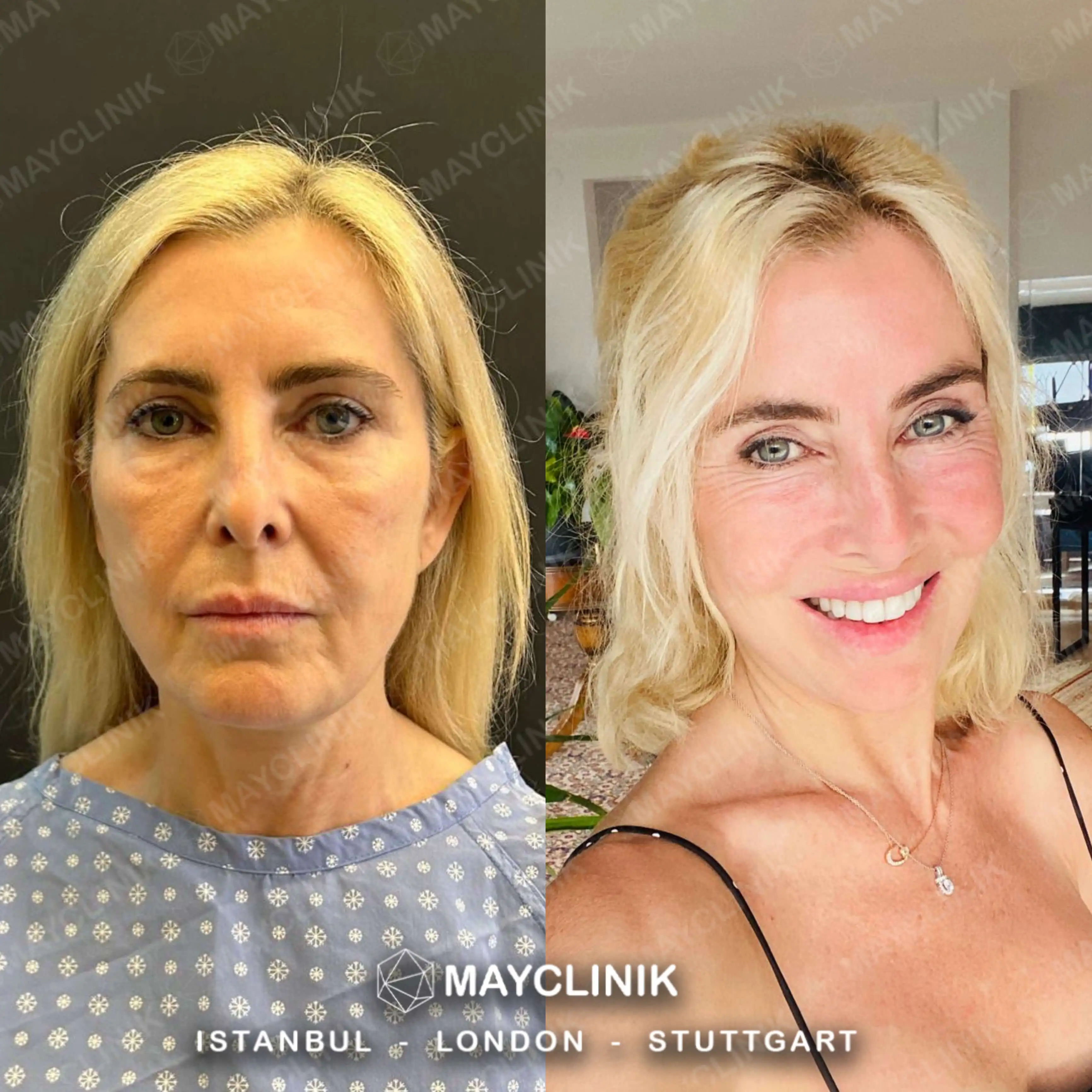 Deep Plane Facelift Before After Result 6