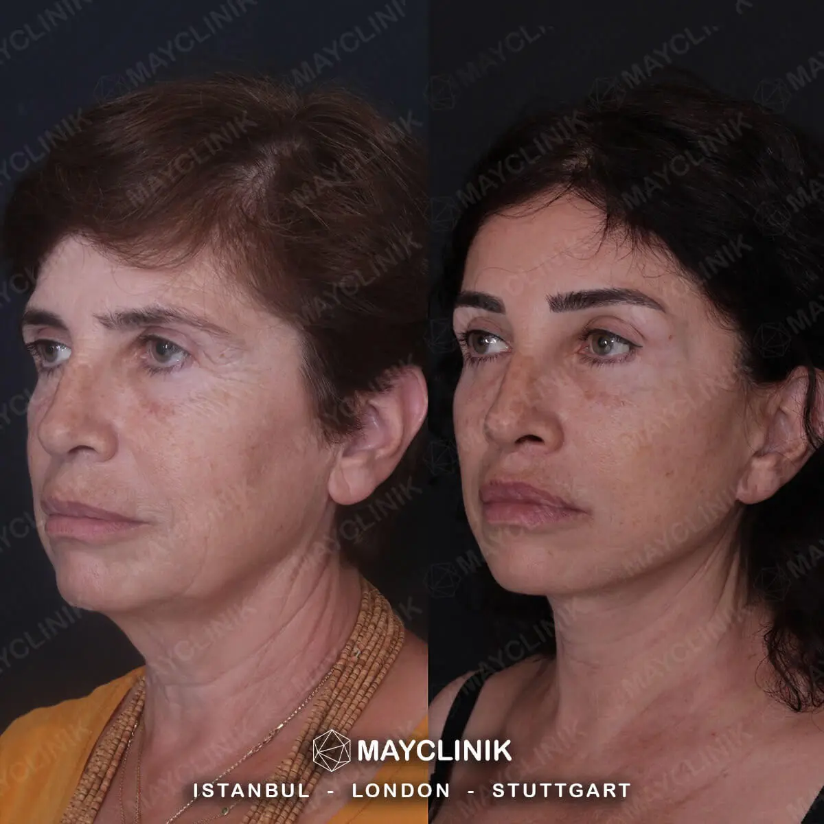 Deep Plane Facelift Before After Result 1