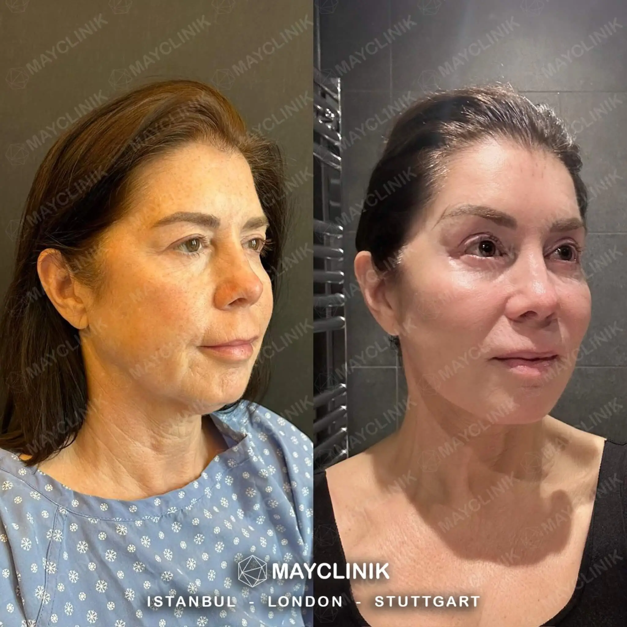 Deep Plane Facelift Before After Result 4