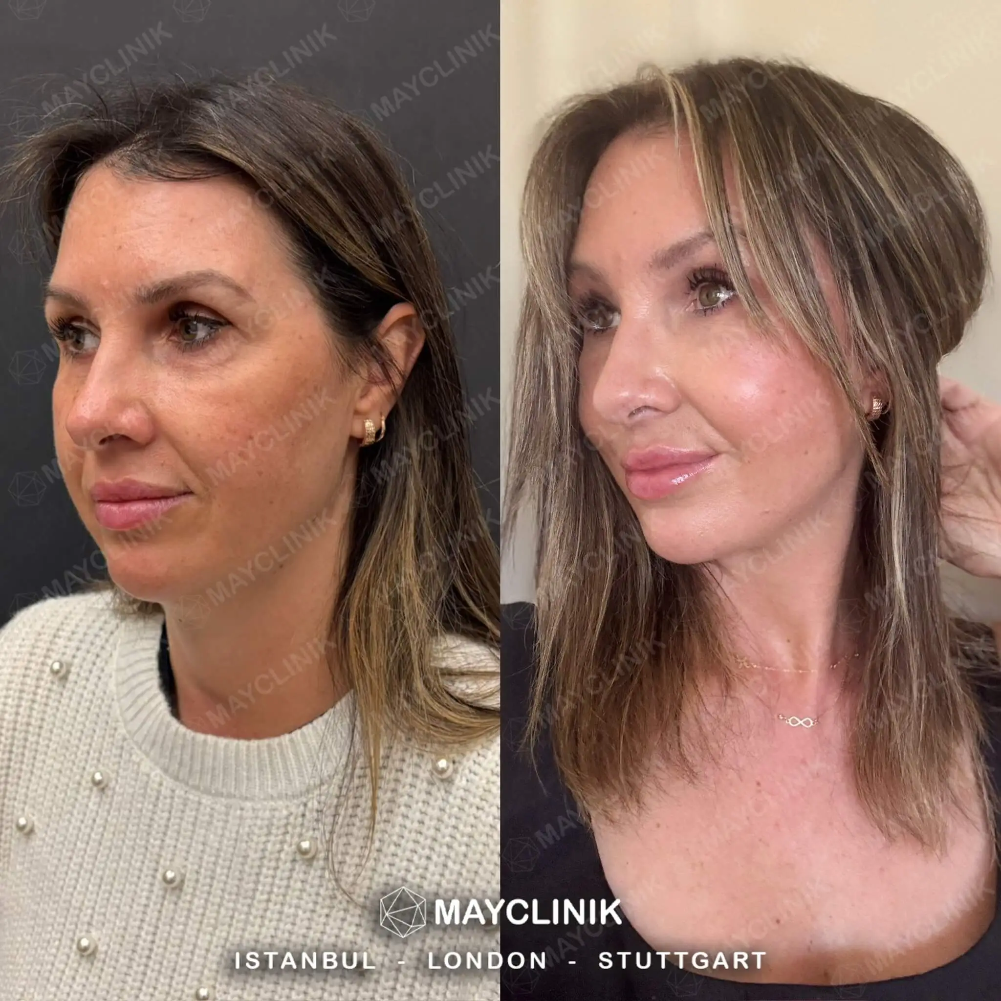Deep Plane Facelift Before After Result 5