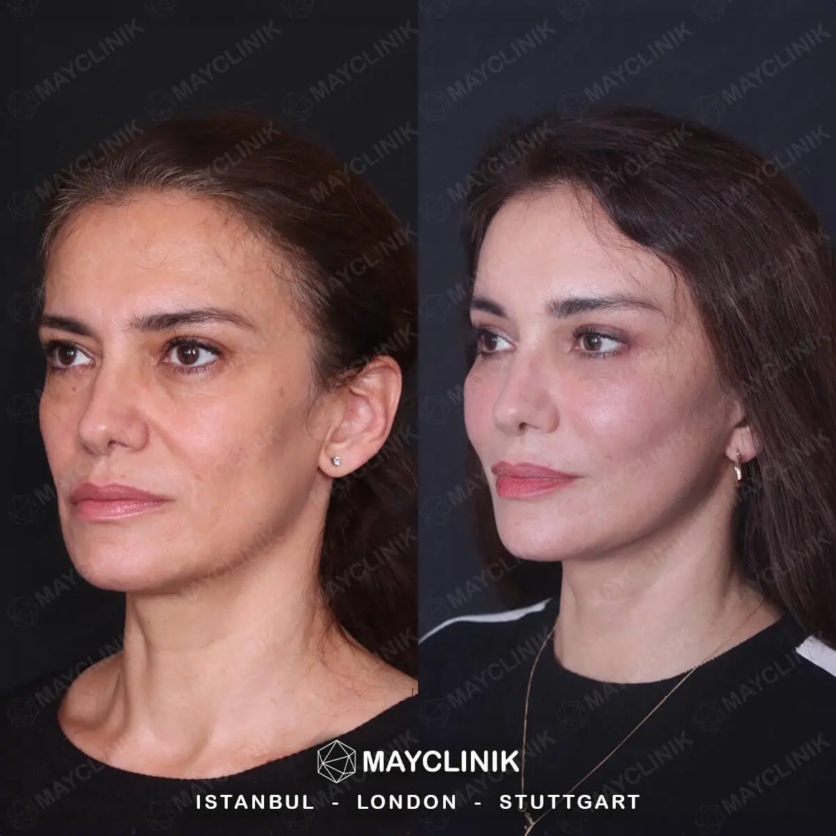Deep Plane Facelift Before After Result 2