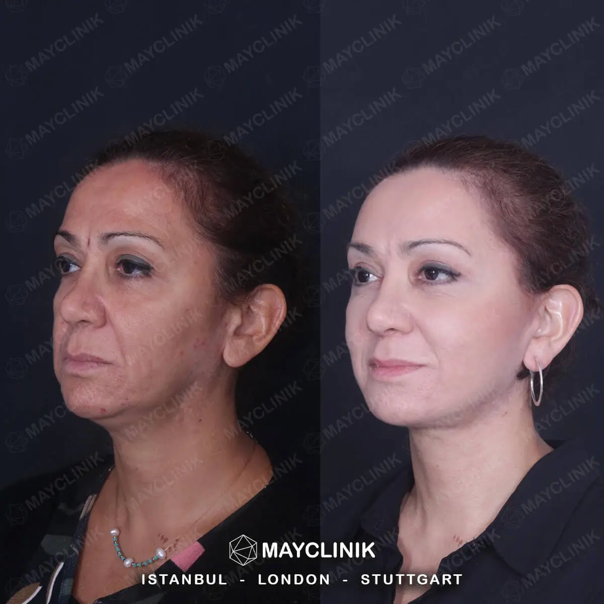 Deep Plane Facelift Before After Result 3