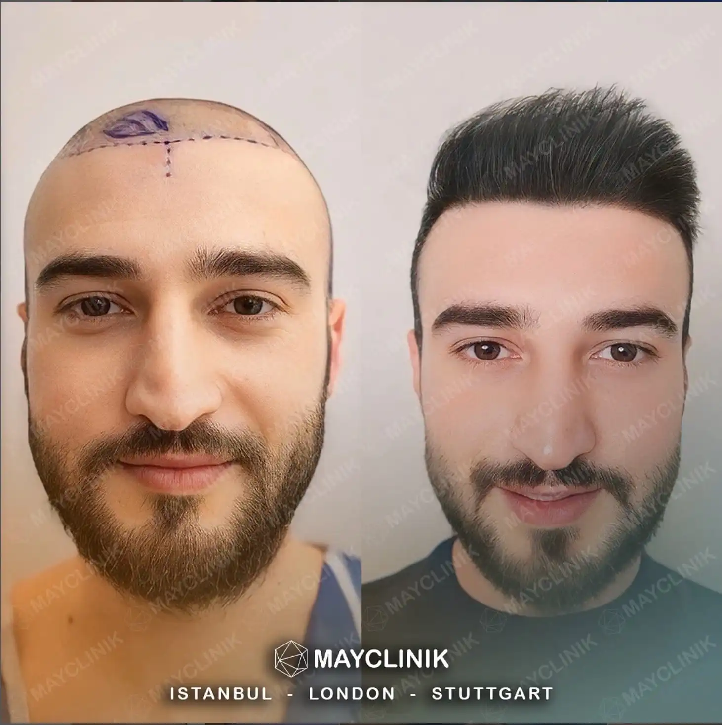 Hair Transplant in Turkey Before After 1
