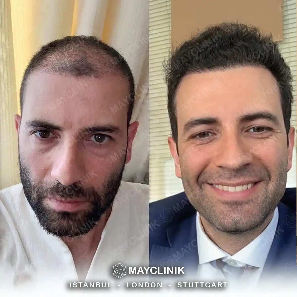 Hair Transplant in Turkey Before After 2