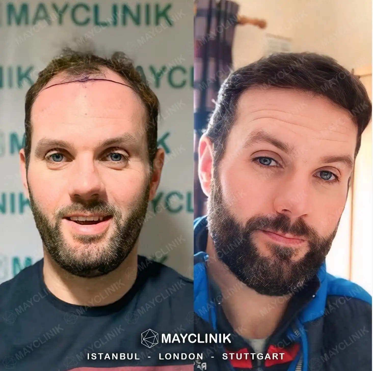 Hair Transplant in Turkey Before After 3