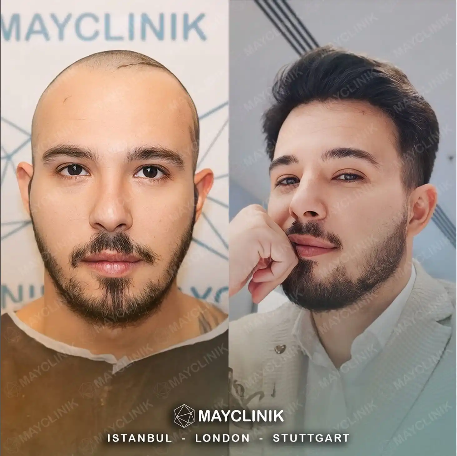 Hair Transplant in Turkey Before After 4