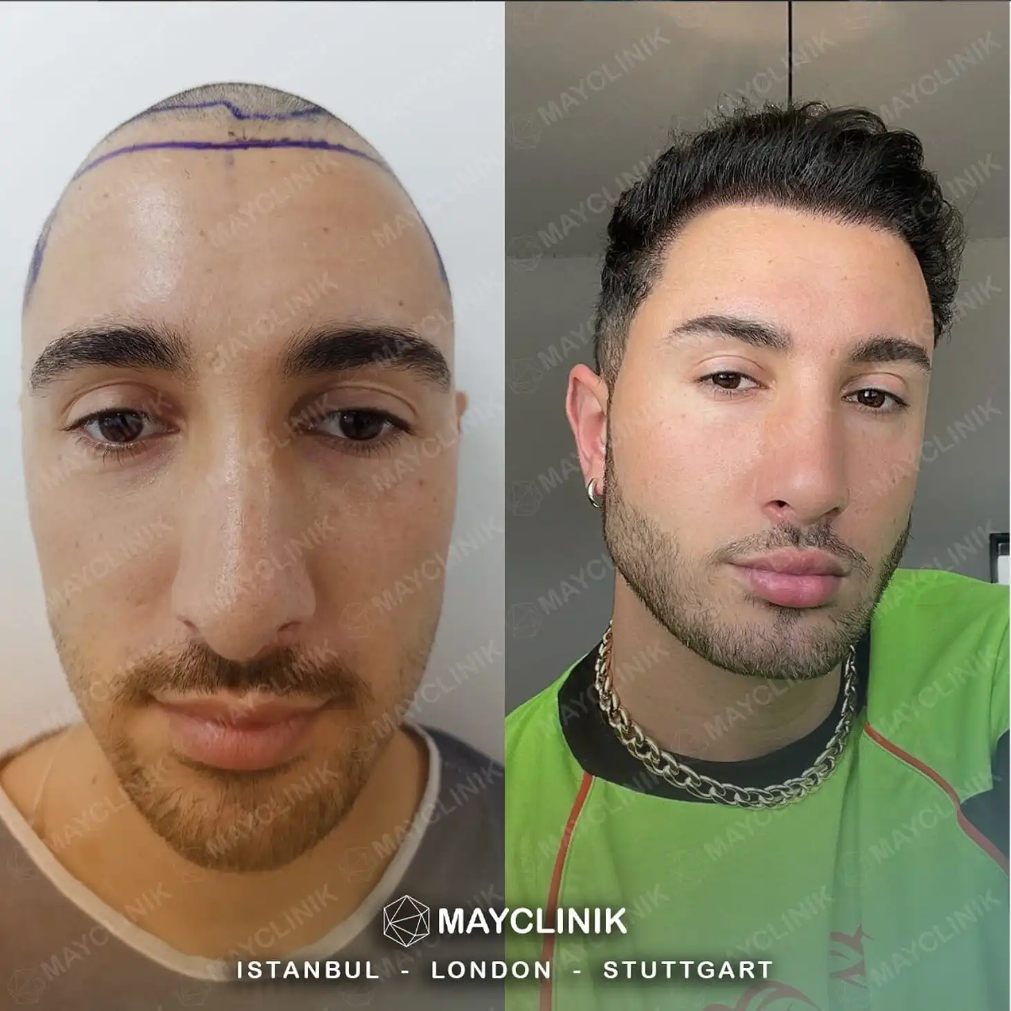 Hair Transplant in Turkey Before After