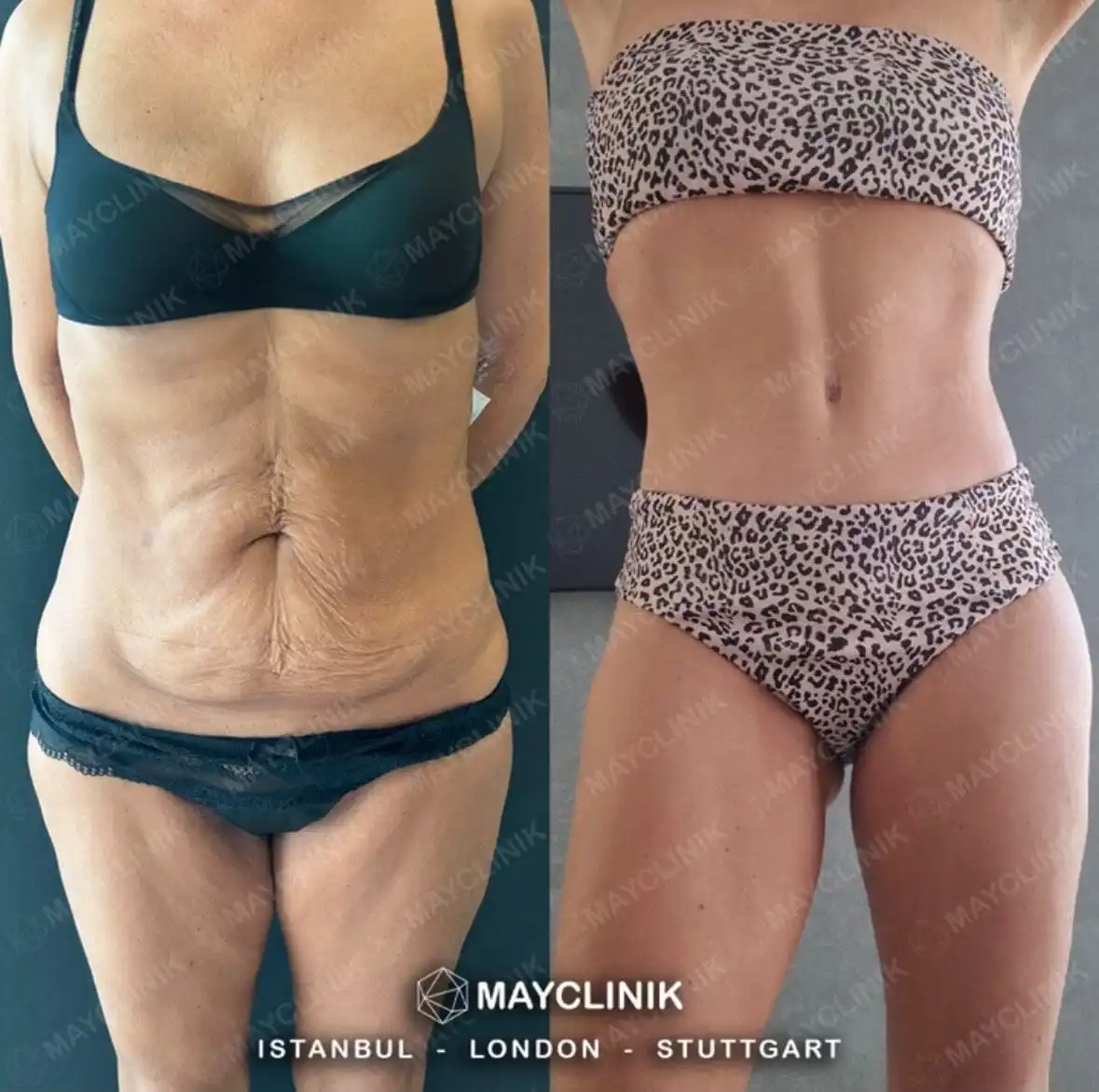 Mommy Makeover Before After Result 10