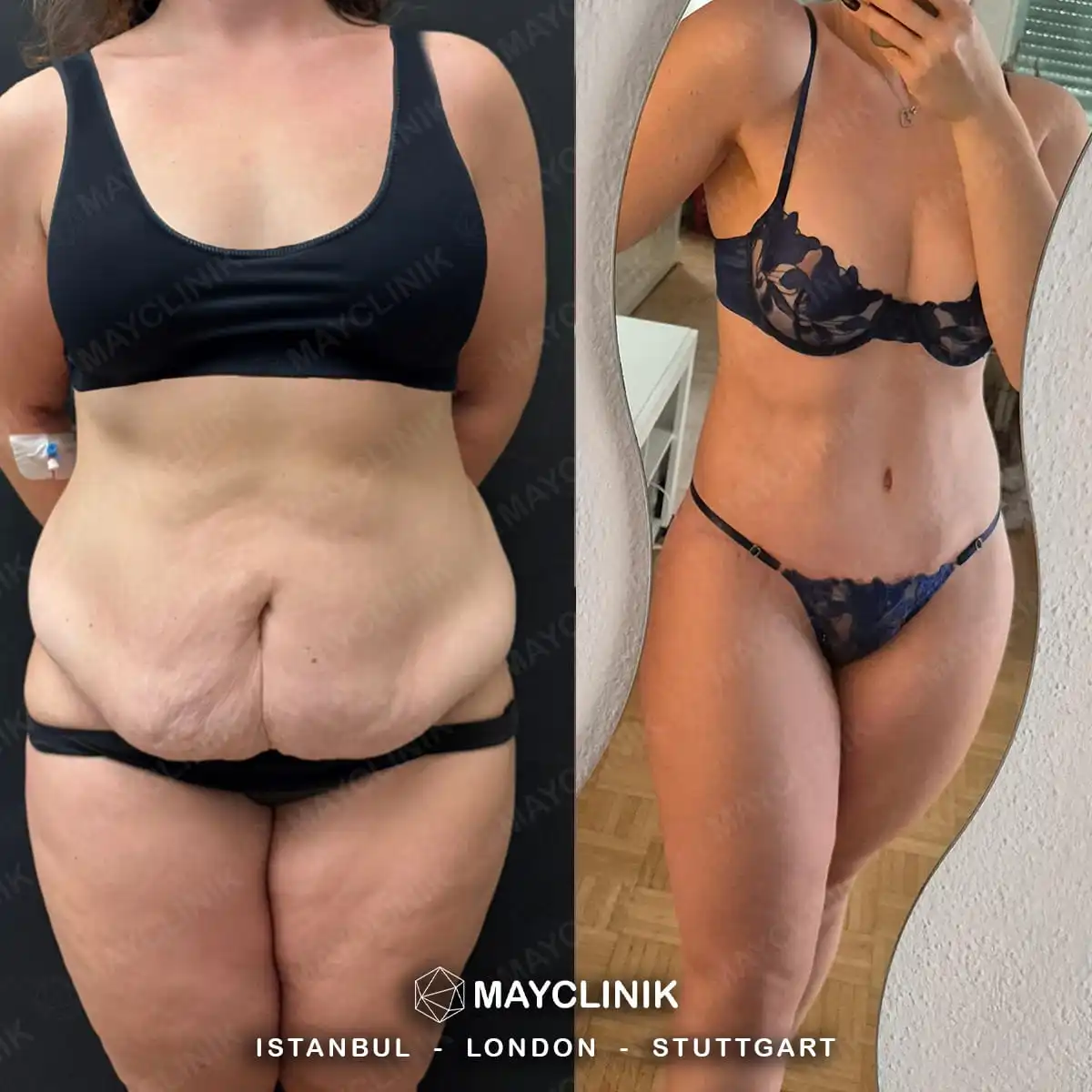 Mommy Makeover Before After Result 11