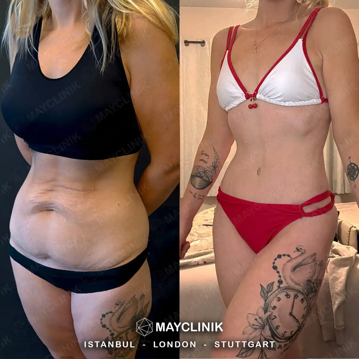 Mommy Makeover Before After Result 12