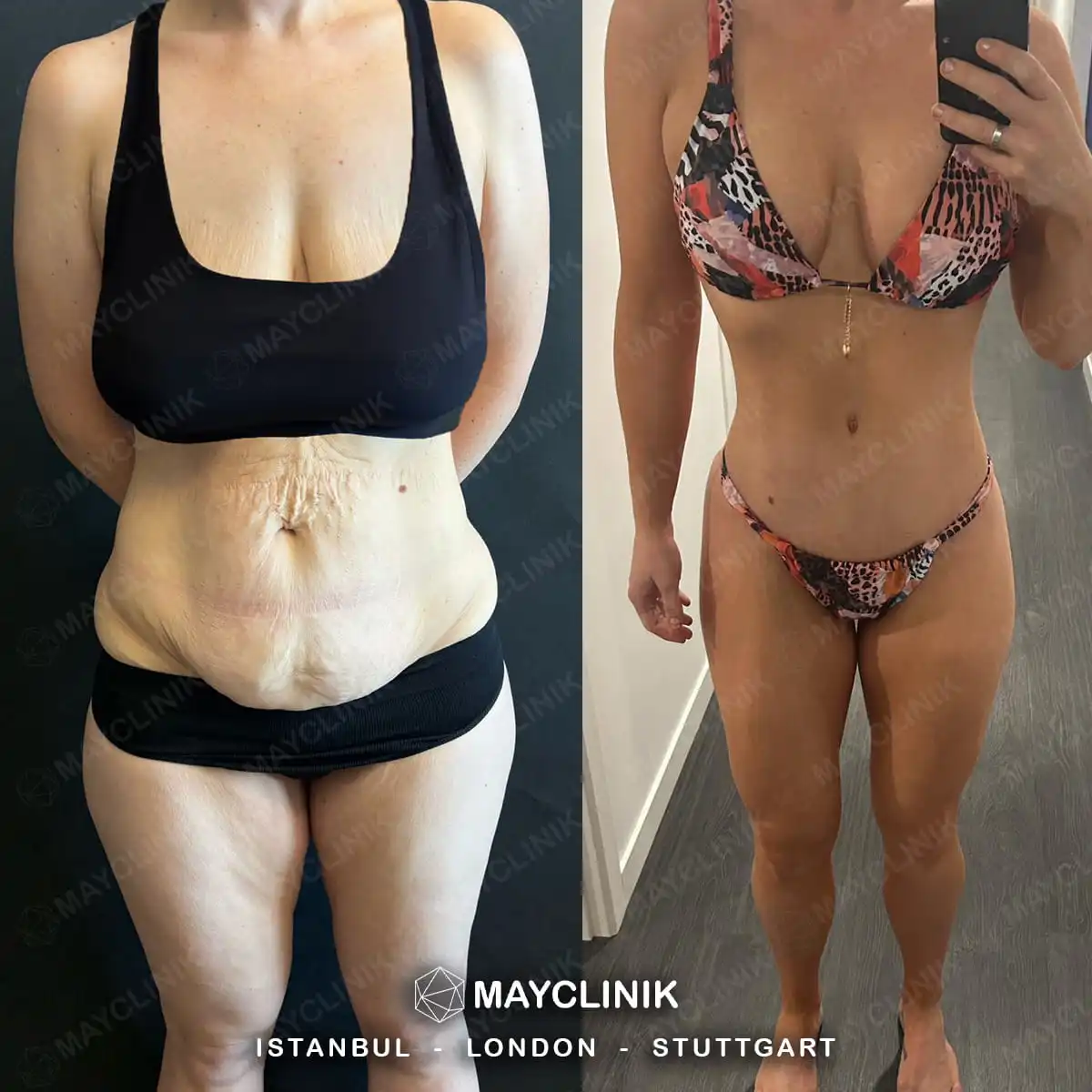 Mommy Makeover Before After Result 8