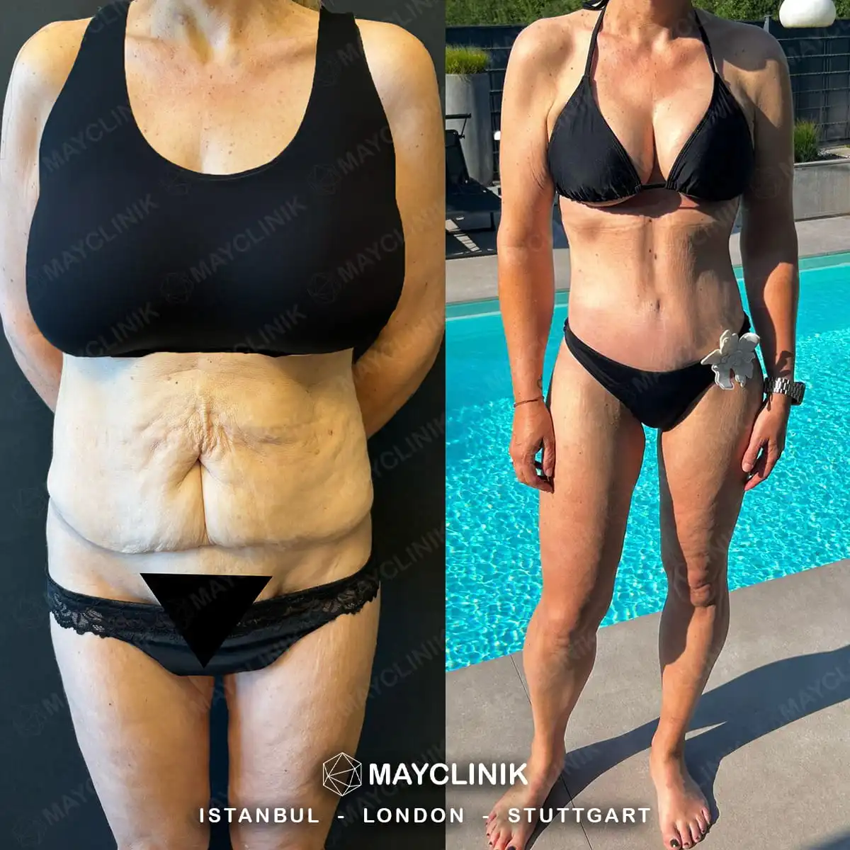 Mommy Makeover Before After Result 9