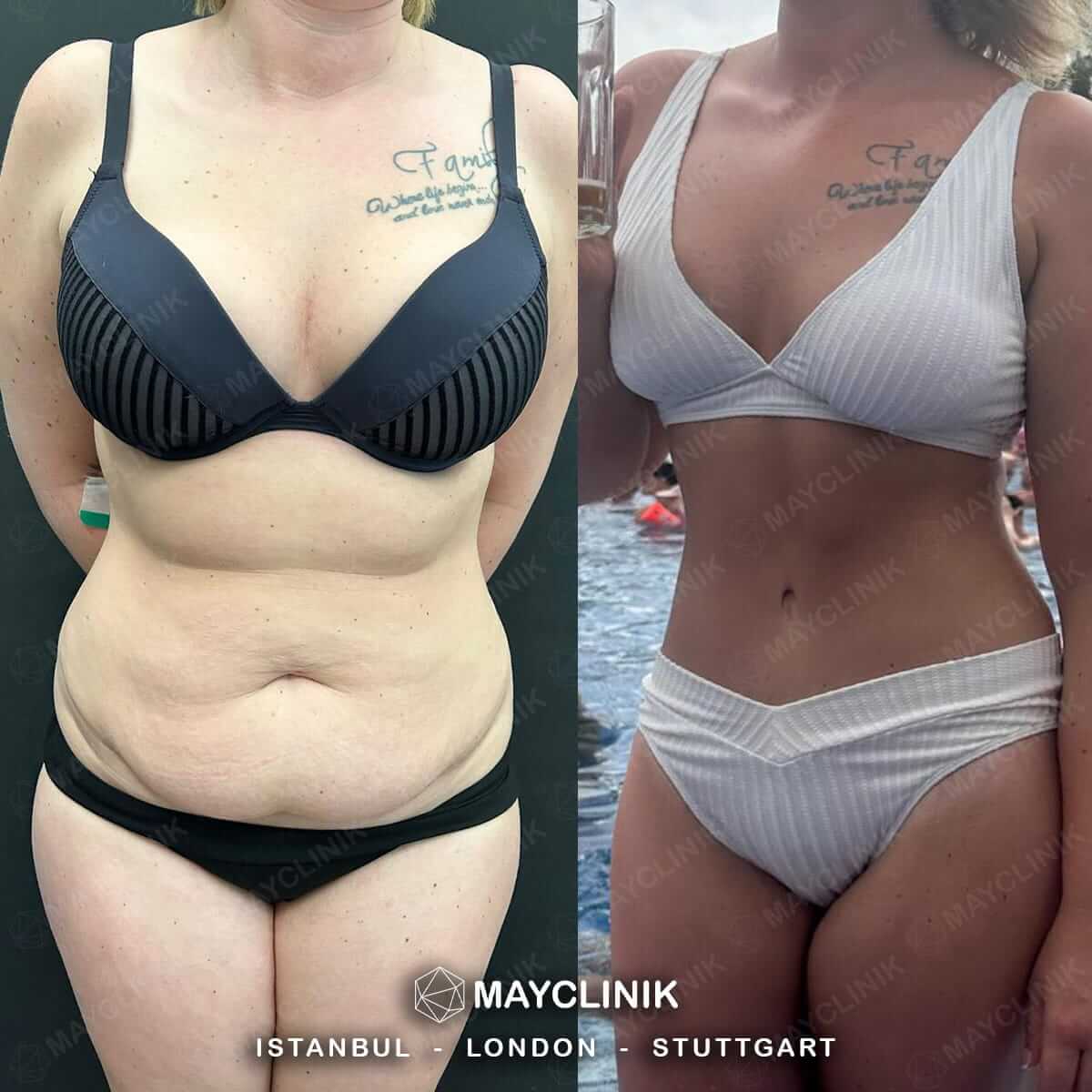 Mommy Makeover Before After Result 6