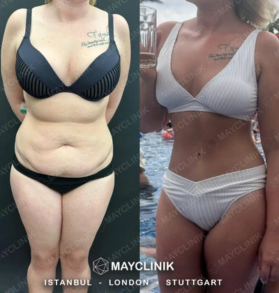 Mommy Makeover Before After Result 6
