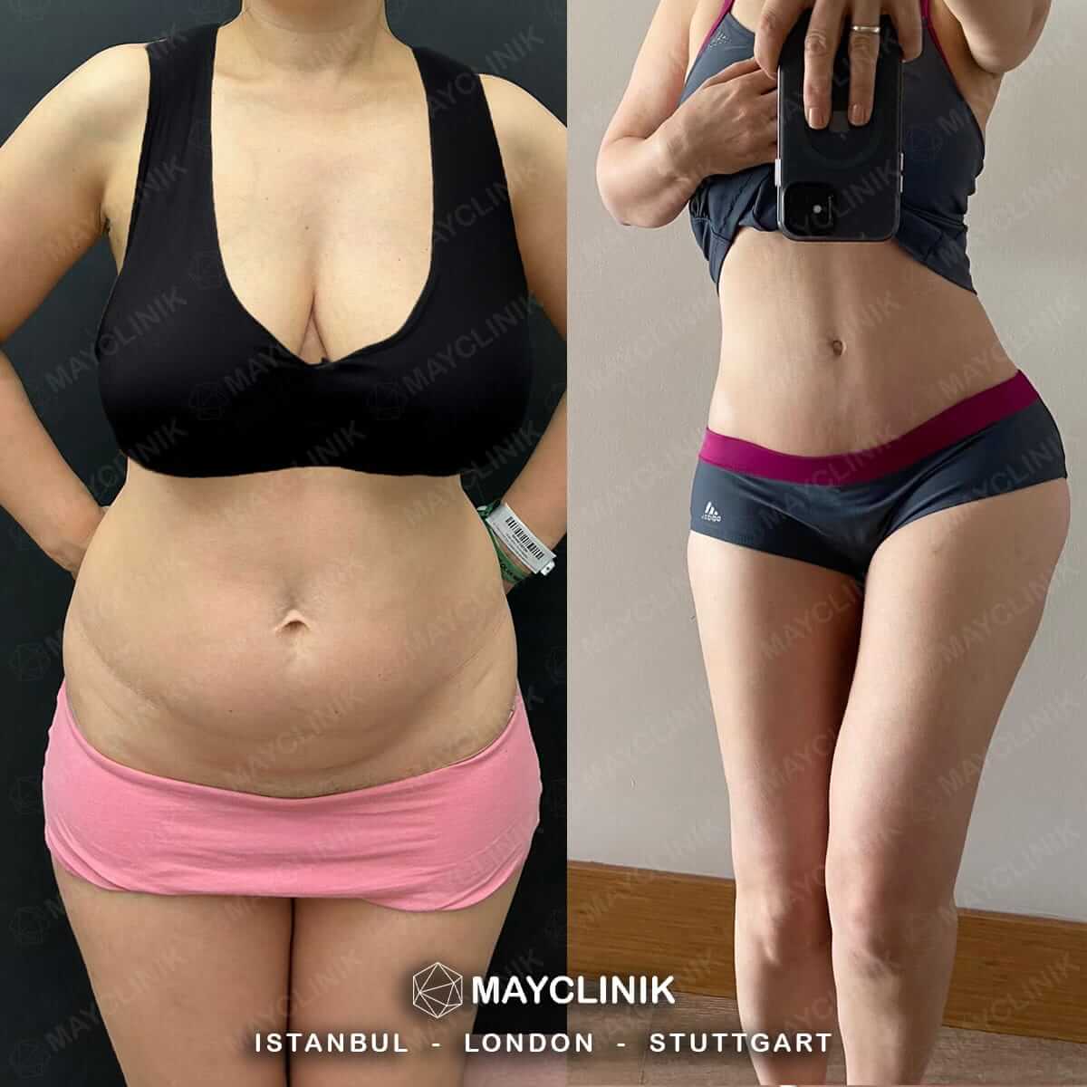 Mommy Makeover Before After Result 5