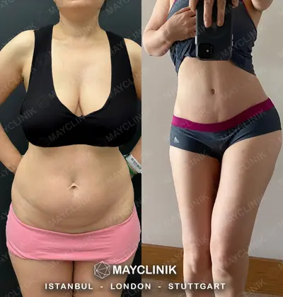 Mommy Makeover Before After Result 5