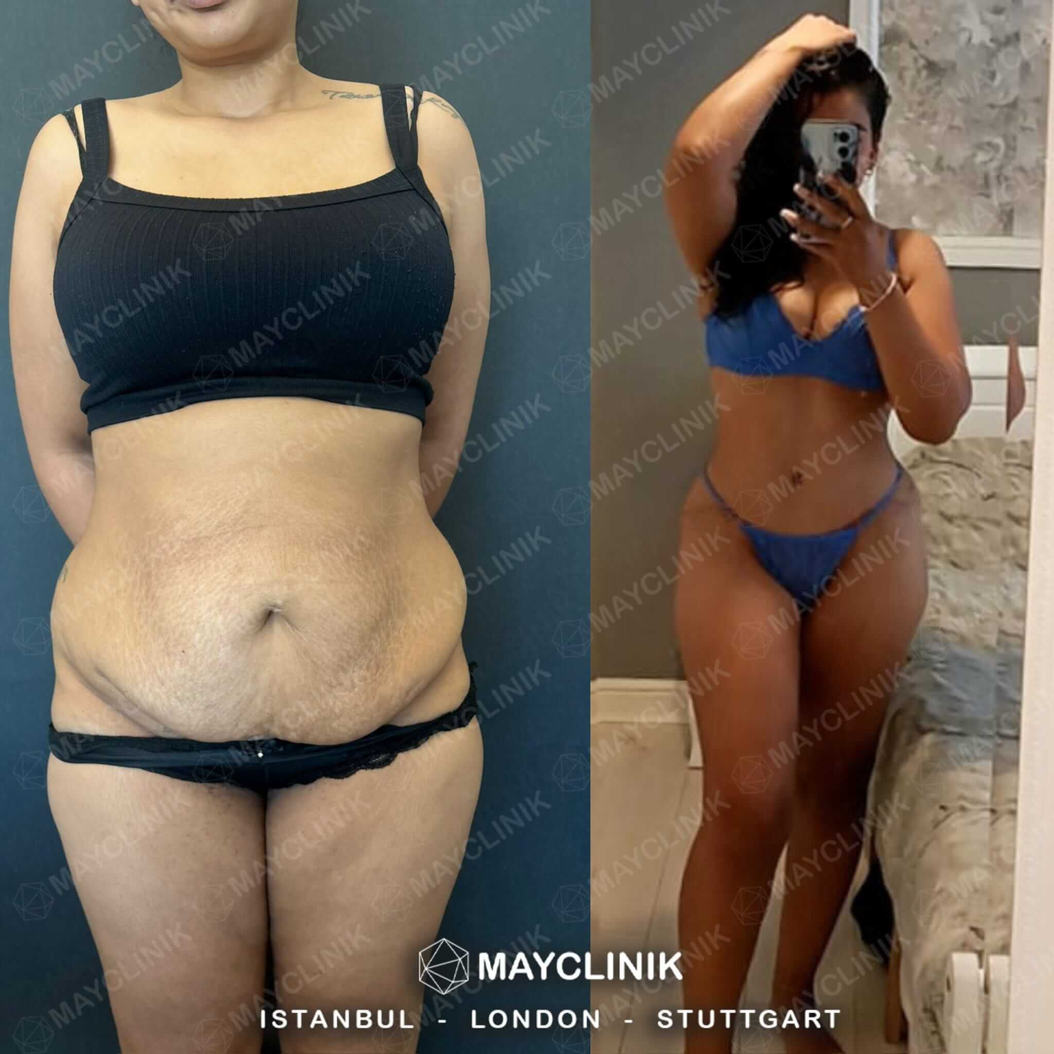 Mommy Makeover Before After Result 3