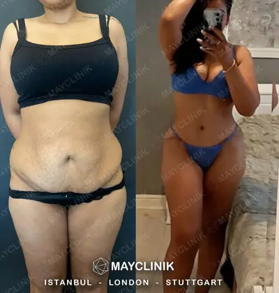 Mommy Makeover Before After Result 3