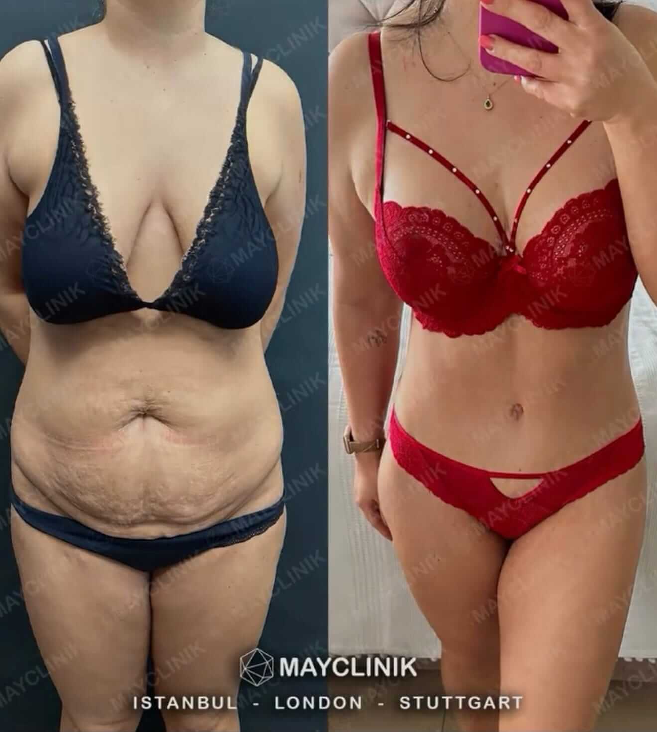 Mommy Makeover Before After Result 4