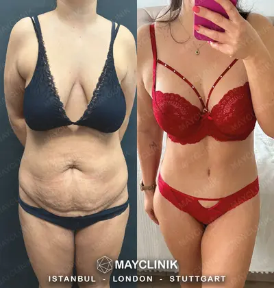 Mommy Makeover Before After Result 4