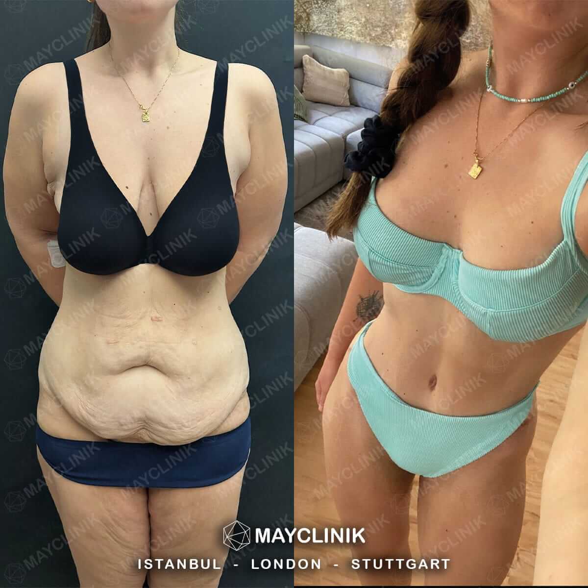 Mommy Makeover Before After Result 2