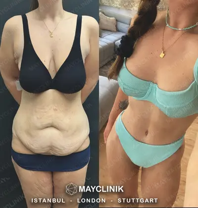 Mommy Makeover Before After Result 2