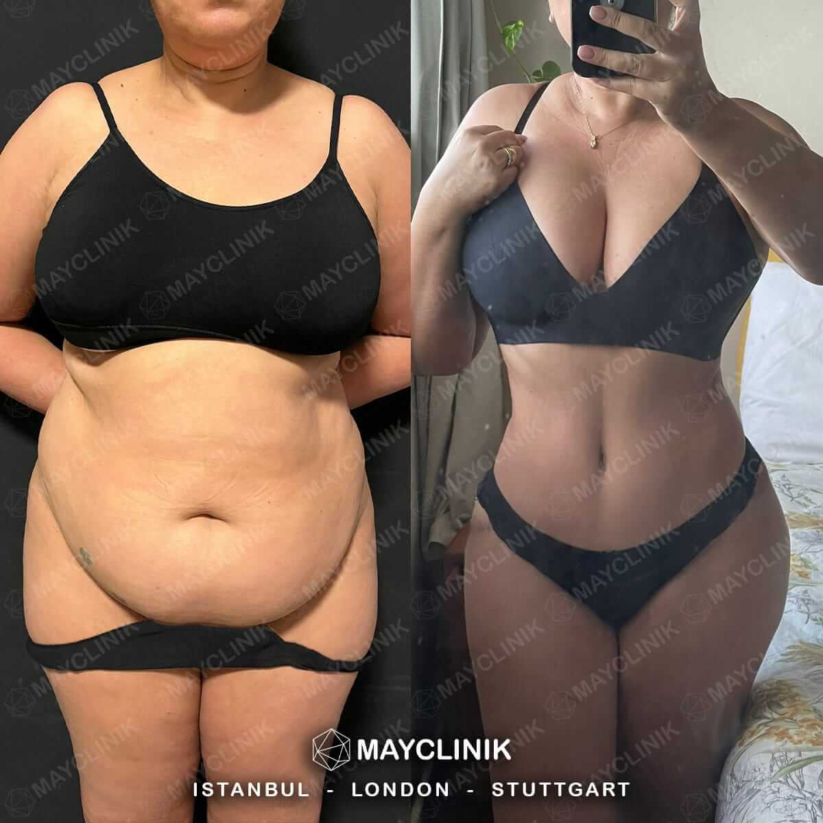 Mommy Makeover Before After Result 1