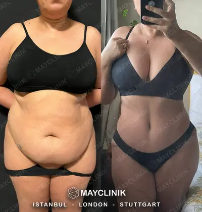 Mommy Makeover Before After Result 1