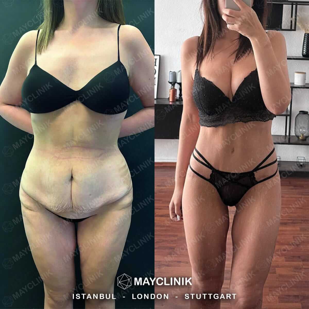 Mommy Makeover Before After Result 7