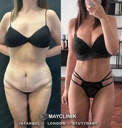 Mommy Makeover Before After Result 7